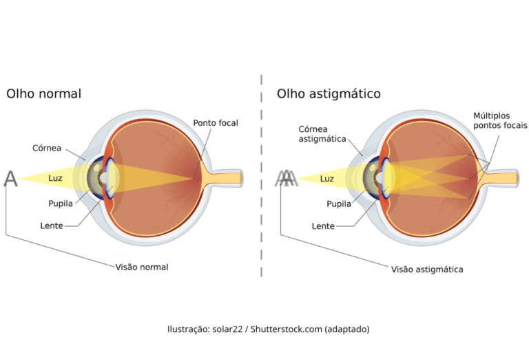 Astigmatismo