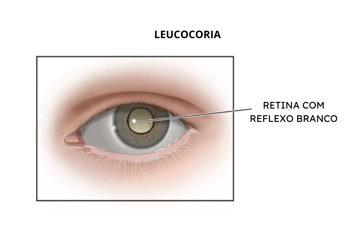 LEUCOCORIA - RETINOBLASTOMA