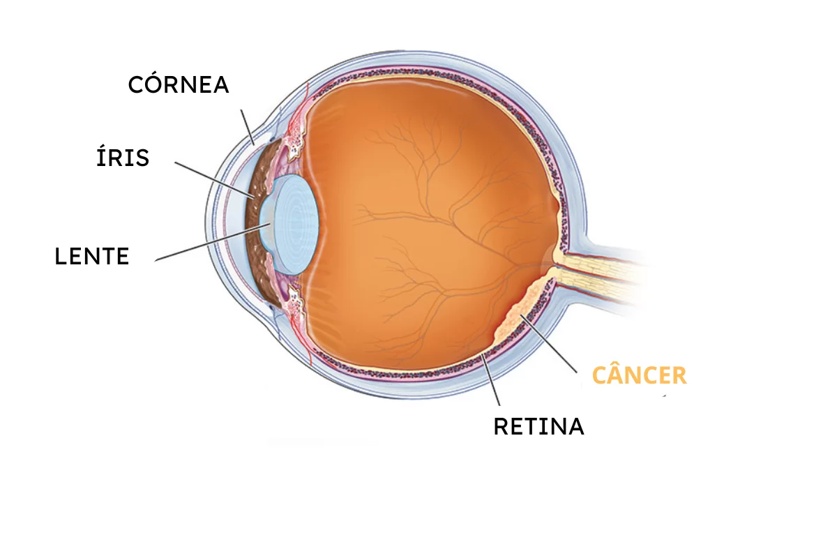 RETINOBLASTOMA