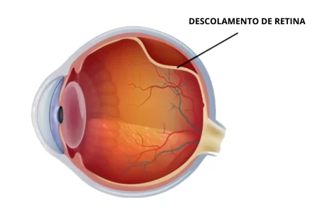 DESCOLAMENTO DE RETINA